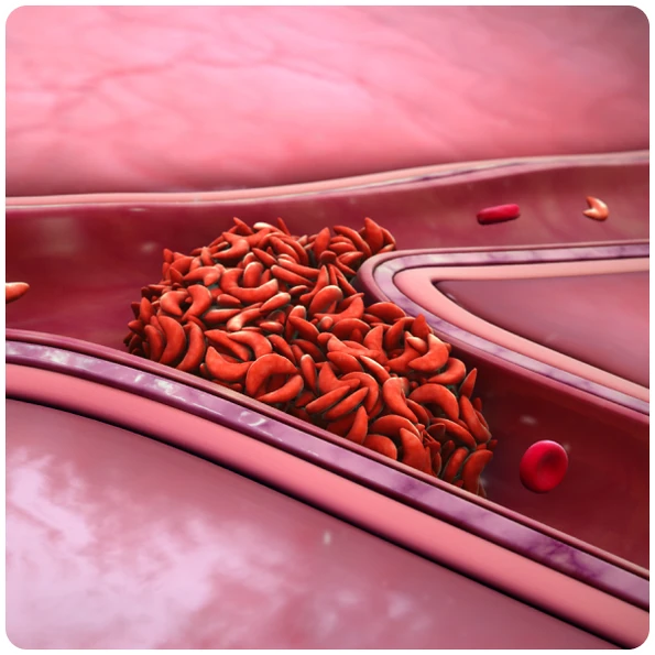 What is Sickle Cell Disease (SCD)?